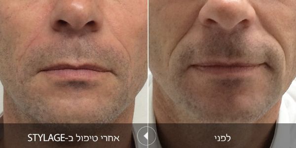 לפני ואחרי טיפול בstylage