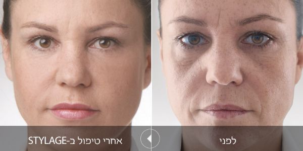 לפני ואחרי טיפול בstylage