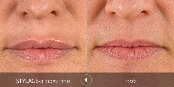 לפני ואחרי טיפול בstylage