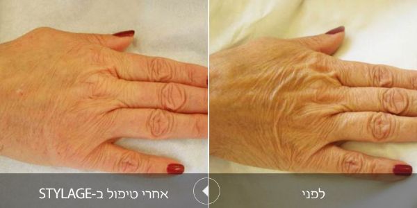 לפני ואחרי טיפול בstylage