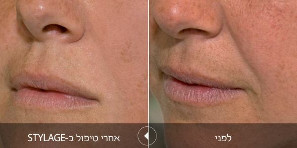לפני ואחרי טיפול בstylage