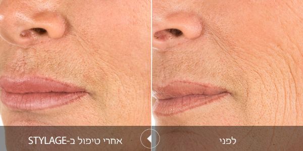 לפני ואחרי טיפול בstylage