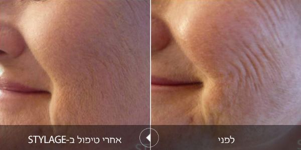 מילוי קמטים