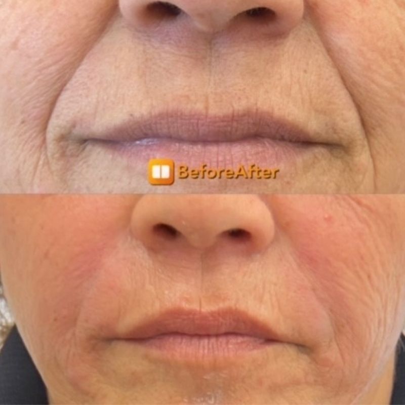 מילוי שפתיים