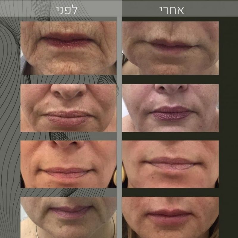 מילוי שפתיים