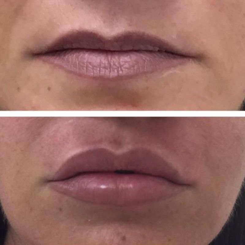 מילוי שפתיים