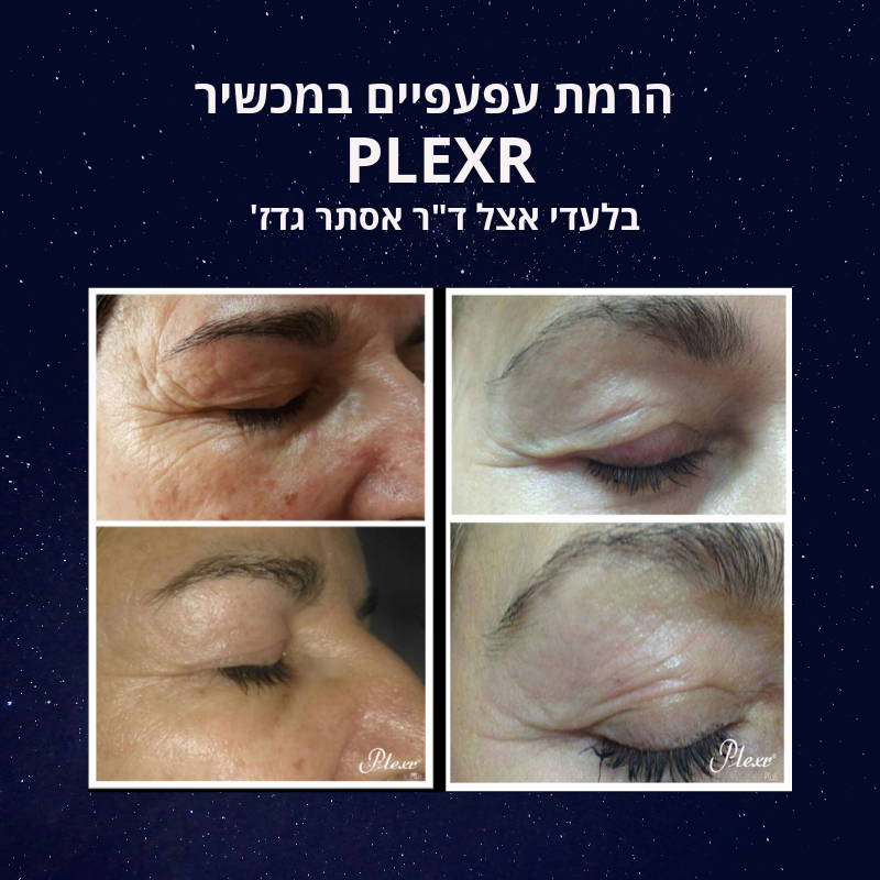 הרמת עפעפיים PLEXR