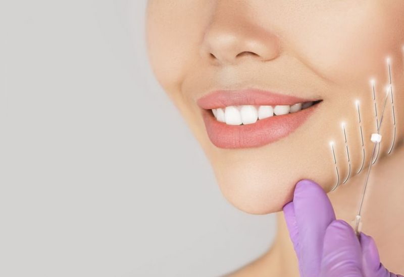 מתיחת פנים באמצעות חוטים